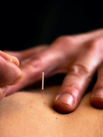 Acupunctuur naald hand